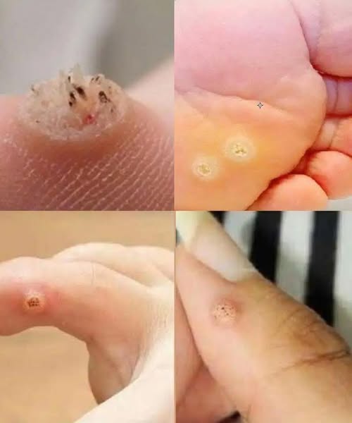 Be Very Careful: If You Notice This Skin Growth, It Could Be Serious